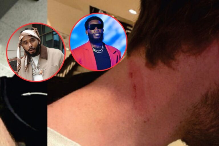 Photos show injuries to alleged Gucci Mane robbery victim
